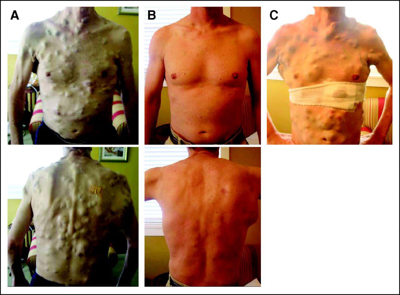 Photographs labeled A, B, and C of a patient treated with a BRAF inhibitor. Resistance is a problem.